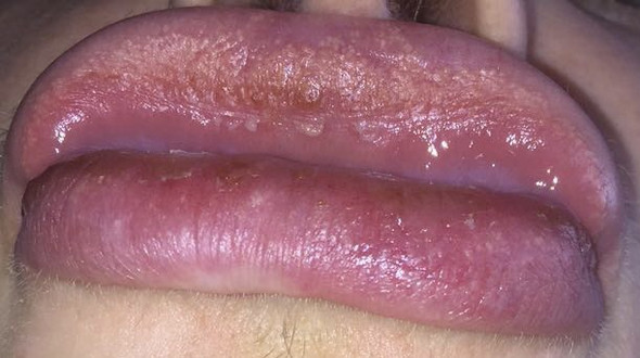 Lippe entzündet und geschwollen  - (Entzündung, Lippe)