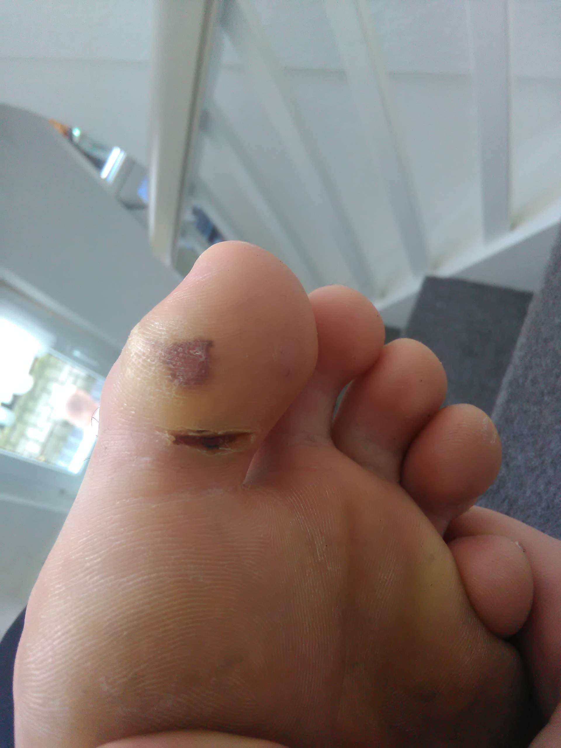 Was Kann Ich Dagegen Tuen Wenn Meine Hornhaut Am Fuss Eingerissen Ist Korper Fusse Wunde Was Kann Ich Dagegen Tuen Wenn Meine Hornhaut Am Fuss Eingerissen Ist Korper Fusse Wunde