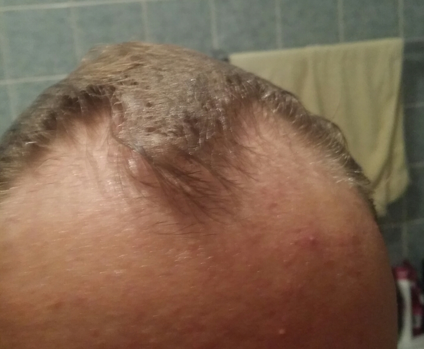Was kann ich endlich gegen mein Haarausfall tun? (Gesundheit