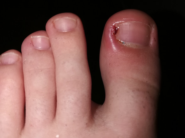 Was kann ich gegen die Entzündung am zeh machen? (Gesundheit und Medizin)