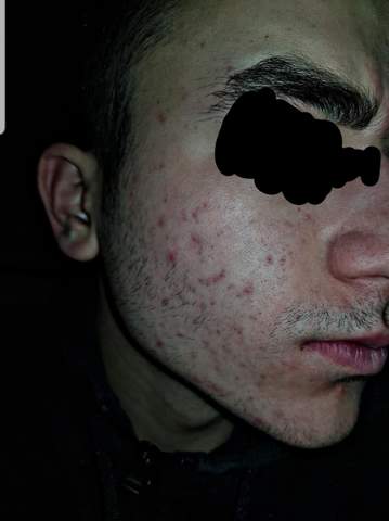 Was Kann Ich Gegen Diese Akne Narben Machen Aussehen