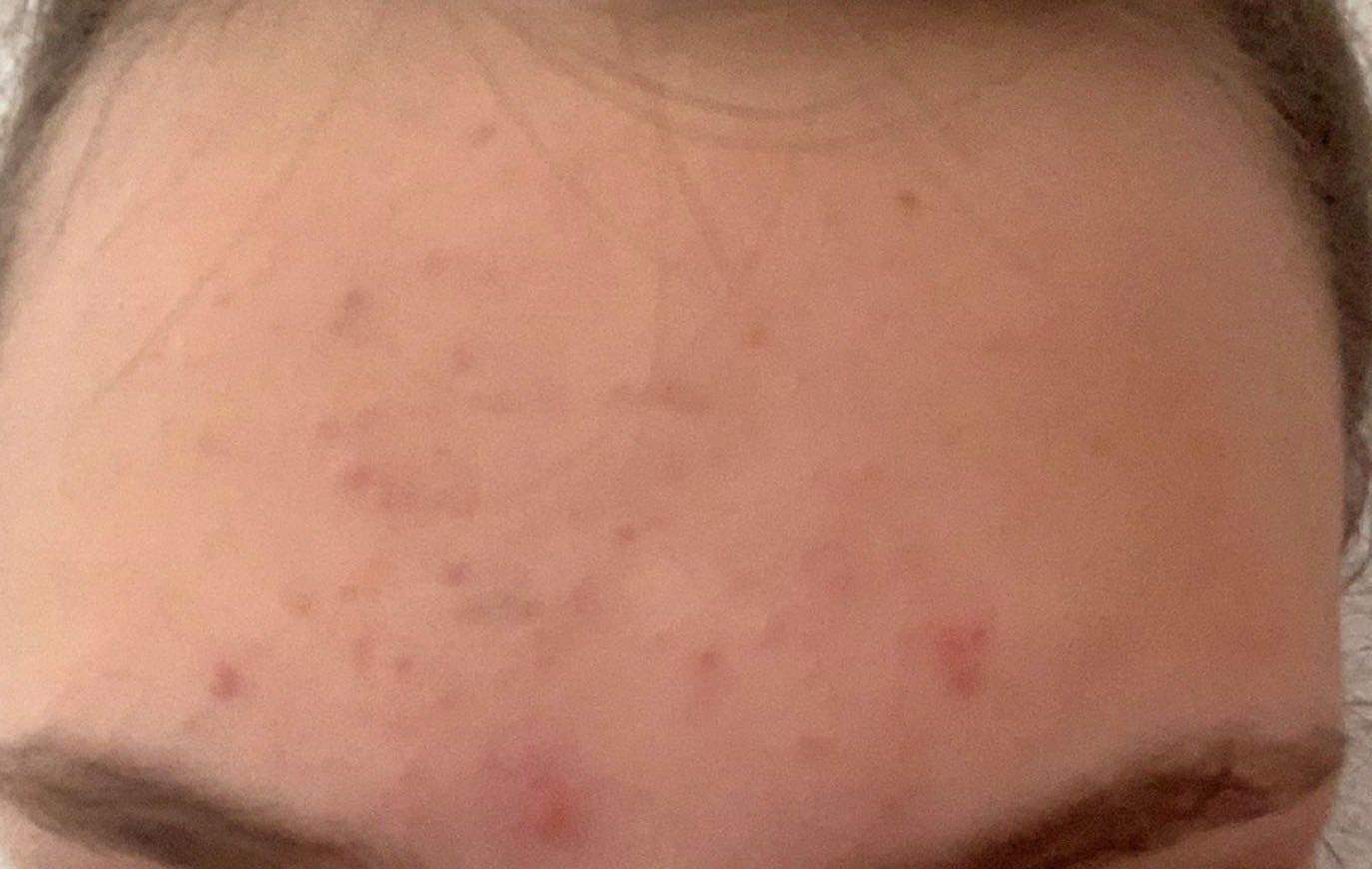 Was kann ich gegen diese Pickel auf der Stirn tun? (Haut) pickel auf der stirn