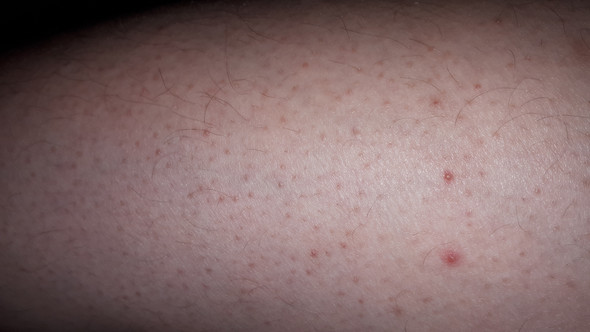 rote punkte und pickel tun