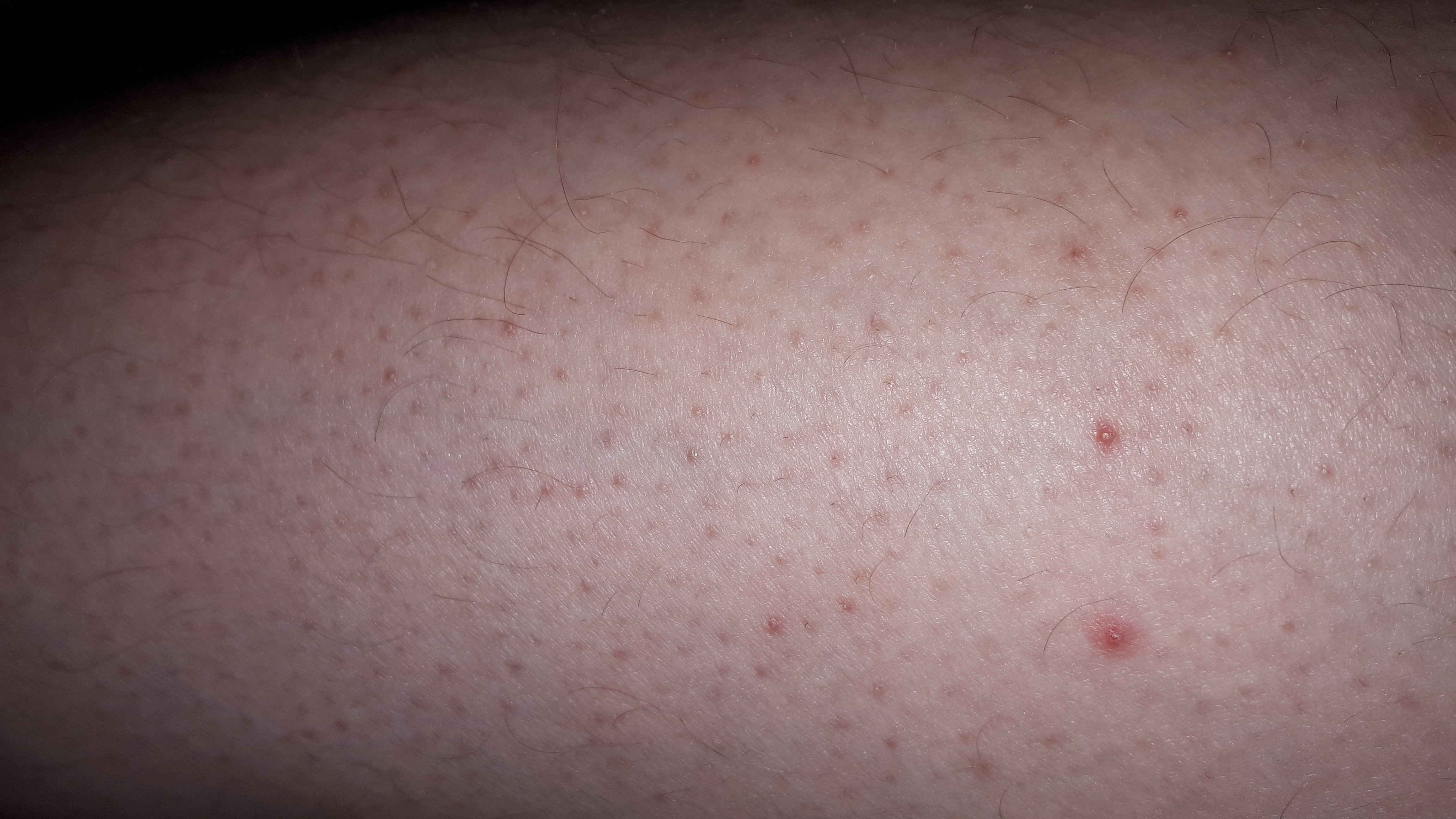 Was kann ich gegen diese rote Punkte und Pickel tun auf meine beiden ...