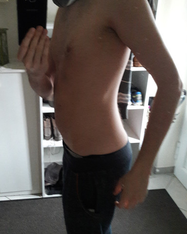 Was Kann Ich Gegen Diese Skoliose Noch Tun Sport Treibe Ich Fast Taglich Bin Drahtig Schmerzen Habe Ich Nicht Aber Optisch Orthopadie Wirbelsaule Was Kann Ich Gegen Diese Skoliose Noch Tun Sport Treibe Ich Fast Taglich Bin Drahtig Schmerzen Habe Ich Nicht Aber Optisch Orthopadie Wirbelsaule