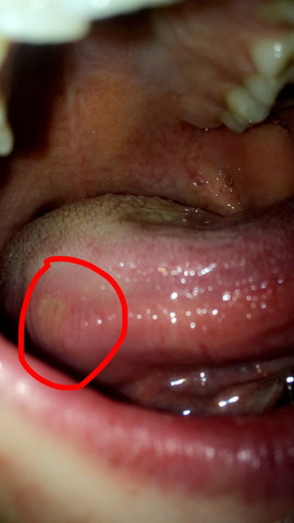 Was Kann Ich Gegen Diese Wunde An Meiner Zunge Tun Gesundheit Und Medizin Gesundheit Korper Was Kann Ich Gegen Diese Wunde An Meiner Zunge Tun Gesundheit Und Medizin Gesundheit Korper