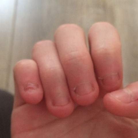 Was Kann Ich Gegen Extremes Nagelkauen Tun Fingernagel Nagelkauen Was Kann Ich Gegen Extremes Nagelkauen Tun Fingernagel Nagelkauen