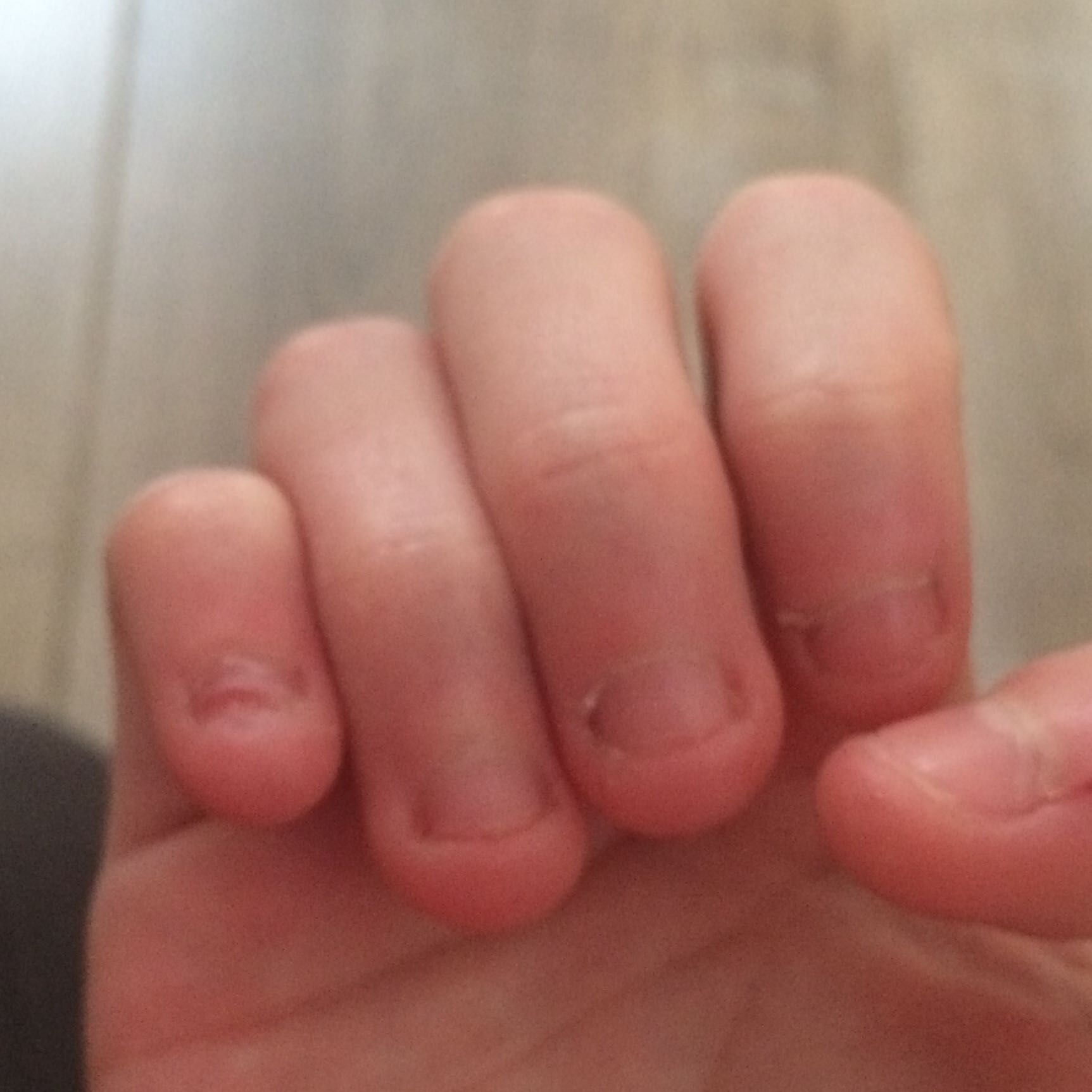 Was kann ich gegen extremes Nagelkauen tun? (Fingernägel ...