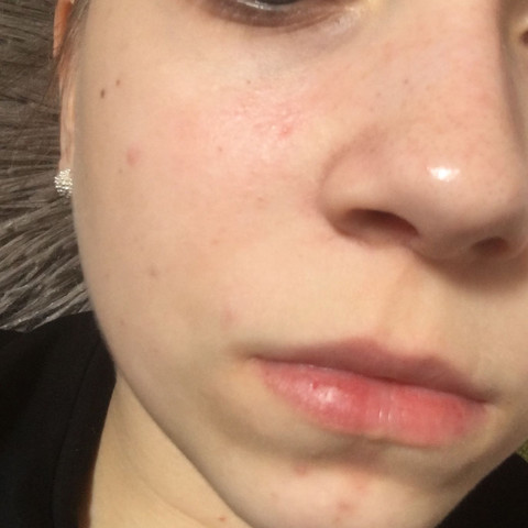 Was Kann Ich Gegen Meine Unreine Haut Im Gesicht Tun Gesundheit Und Medizin Pickel Was Kann Ich Gegen Meine Unreine Haut Im Gesicht Tun Gesundheit Und Medizin Pickel