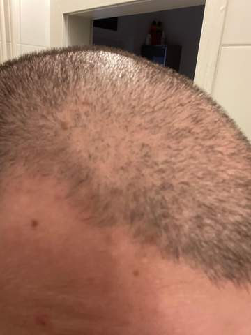 Was kann ich gegen meinen Haarausfall machen?