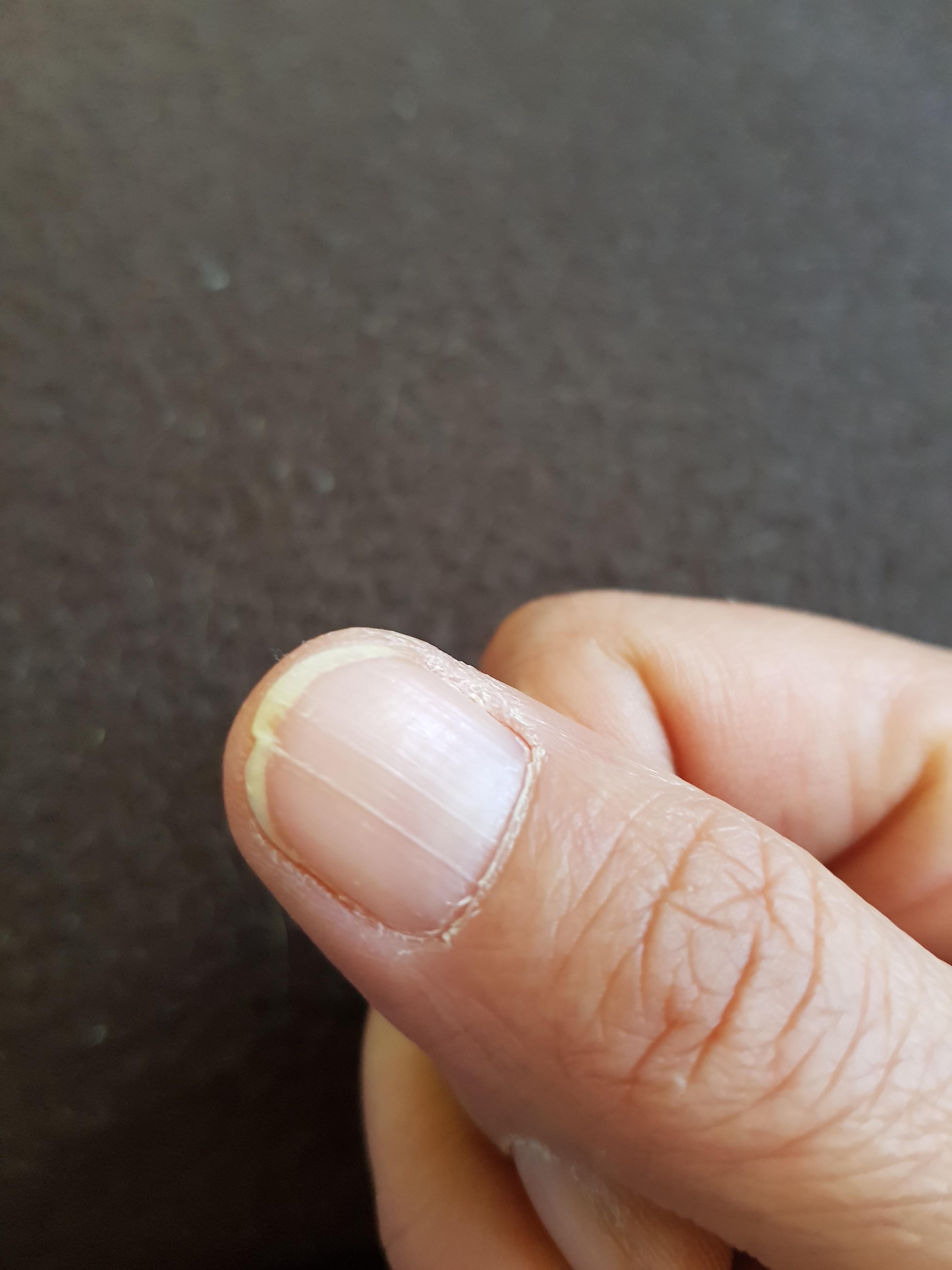 Was kann ich gegen meinen Spaltnagel tun? (Beauty, Kosmetik, Fingernägel)