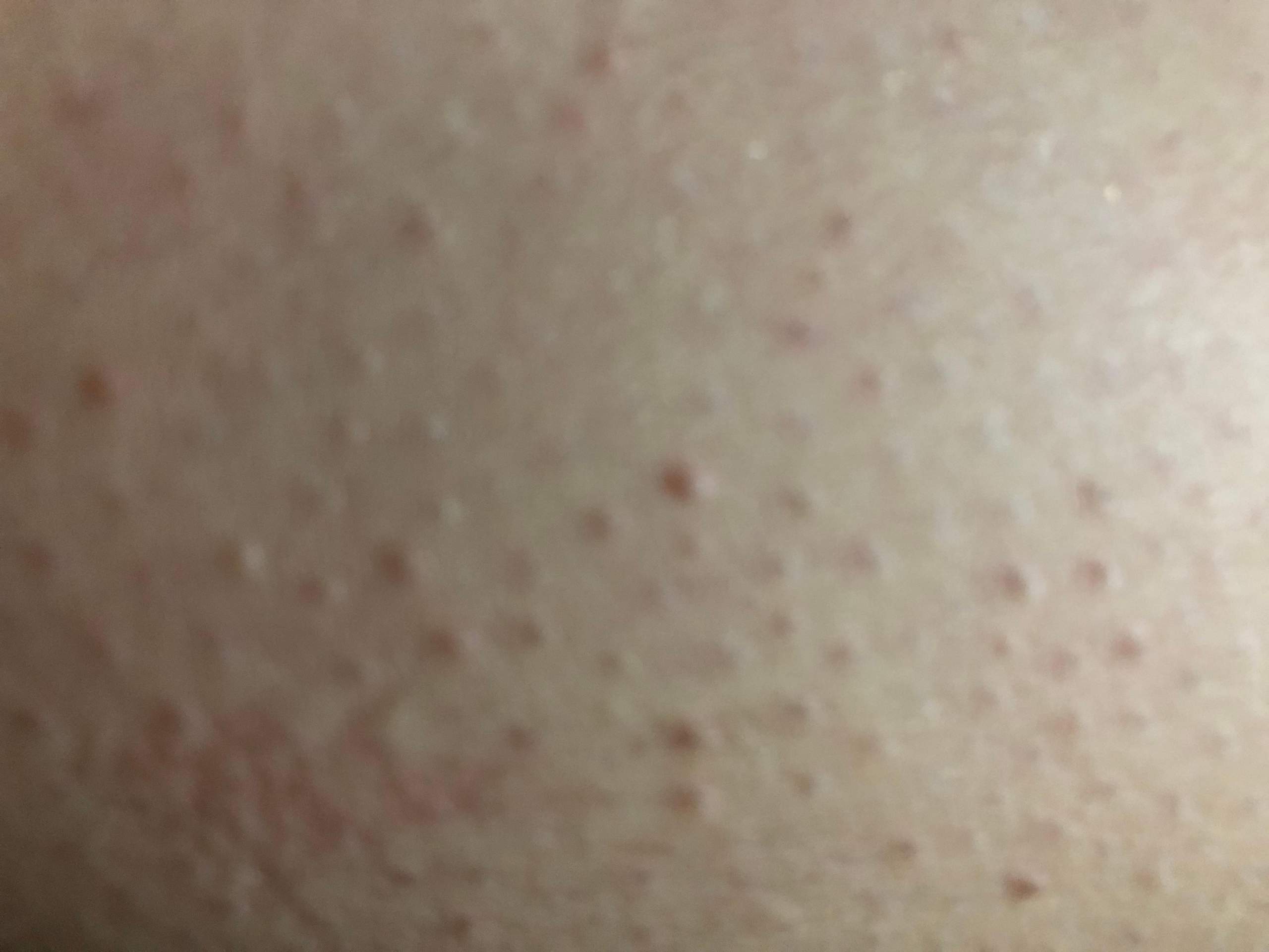 Was kann ich gegen Pickel an den Beinen tun? (Gesundheit und Medizin, Haut, Beine)