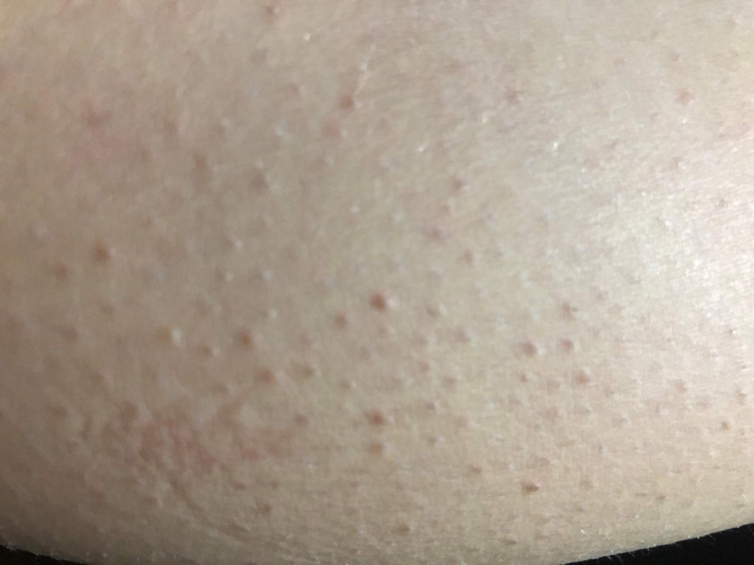 Was kann ich gegen Pickel an den Beinen tun? (Gesundheit und Medizin, Haut, Beine)