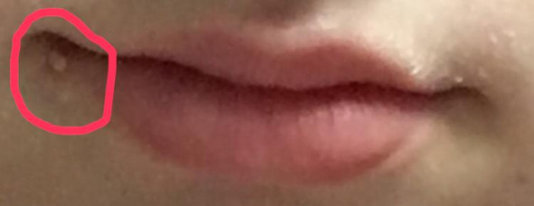 34+ Pickel Im Mundwinkel Was Tun Pics