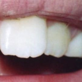 Was Kann Ich Gegen Solche Abgeknirschten Zahne Tun Bilder Zahnarzt Kaputt Was Kann Ich Gegen Solche Abgeknirschten Zahne Tun Bilder Zahnarzt Kaputt