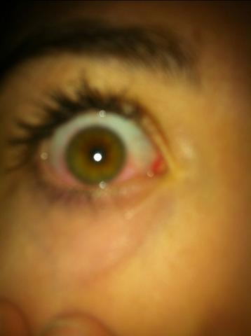Das ist mein Auge wo es rot ist - (Hochzeit, Kontaktlinsen, Hirnhautentzündung)