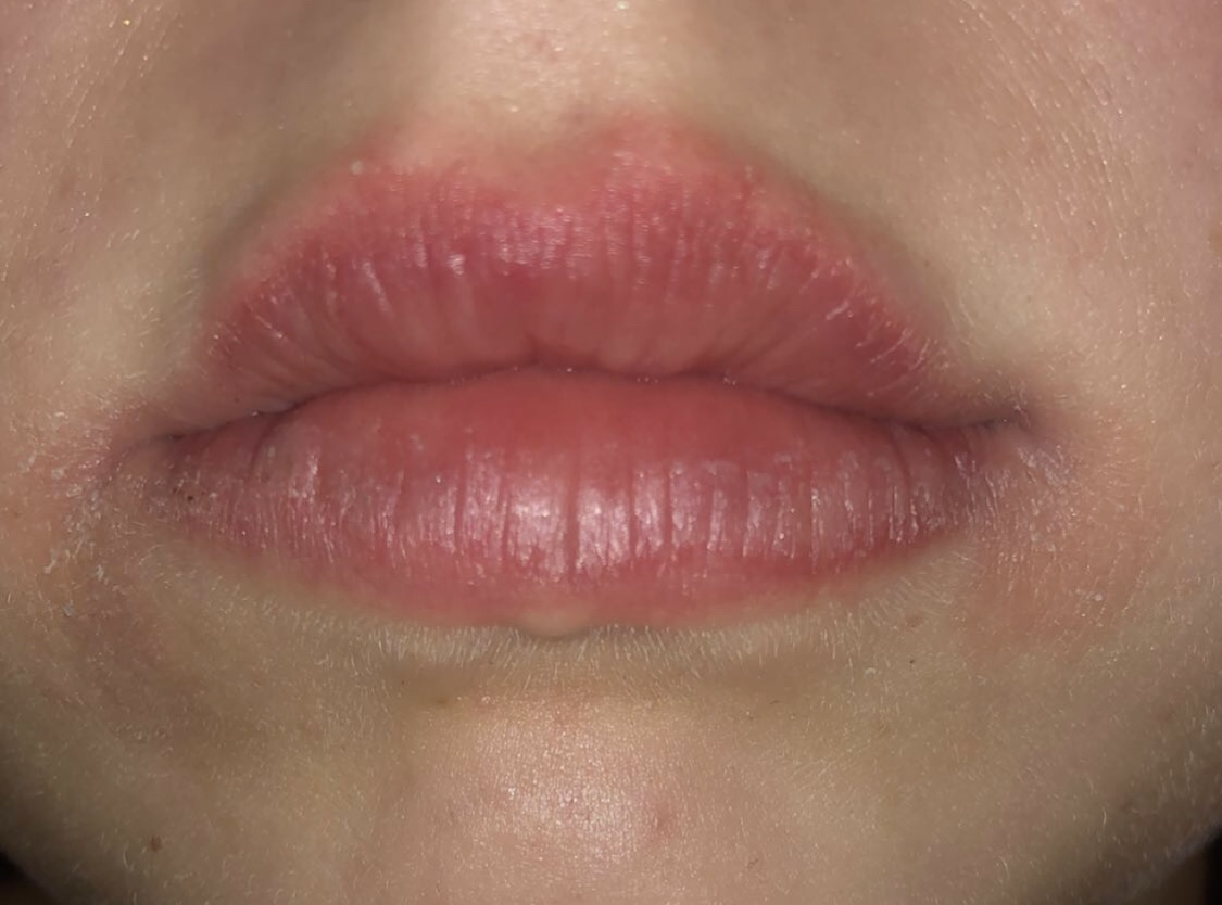 Was kann ich machen (Lippe rot ,entzündet? (Gesundheit und Medizin