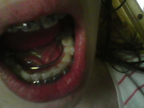 Was Kann Ich Mit Fester Zahnspange Und Lingualbogen Essen