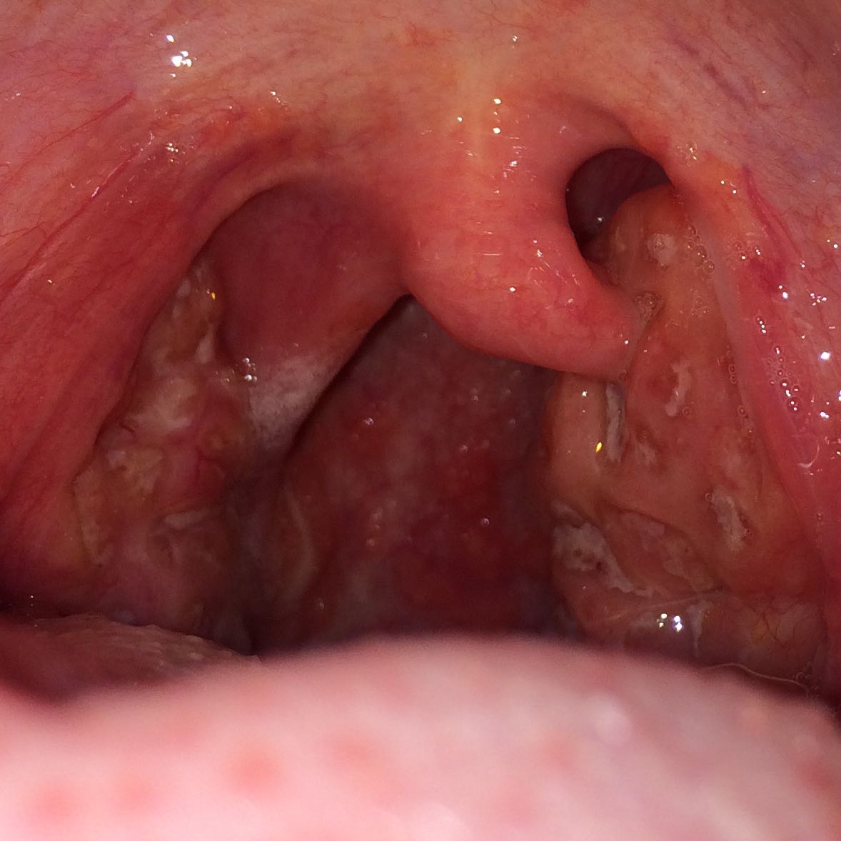 Was kann ich tun damit meine Mandel wieder abschwillt? (Hals Was kann ich tun damit meine Mandel wieder abschwillt? (Hals