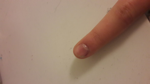 Was Kann Man Bei So Einem Nagel Machen Fingernagel Notfall