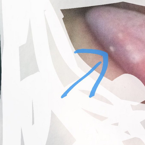 Was kann man dagegen machen zunge entzündung? (Gesundheit ...