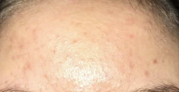 pickel auf der brust mann