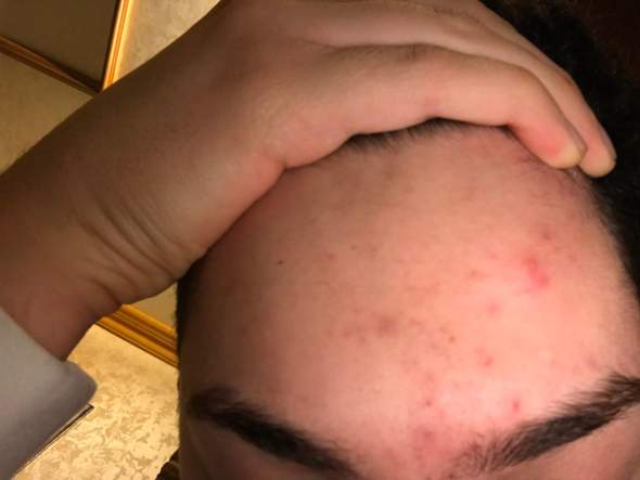 Was Kann Man Gegen Diese Pickel Tun Haut Gesicht Hautprobleme Was Kann Man Gegen Diese Pickel Tun Haut Gesicht Hautprobleme