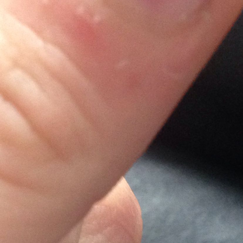 Was Kann Man Gegen Diese Risse Tun Hand Finger Was Kann Man Gegen Diese Risse Tun Hand Finger