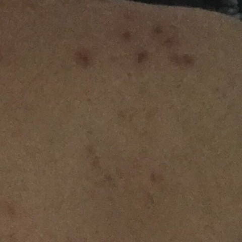 Get Pickelmale Am Po Loswerden PNG