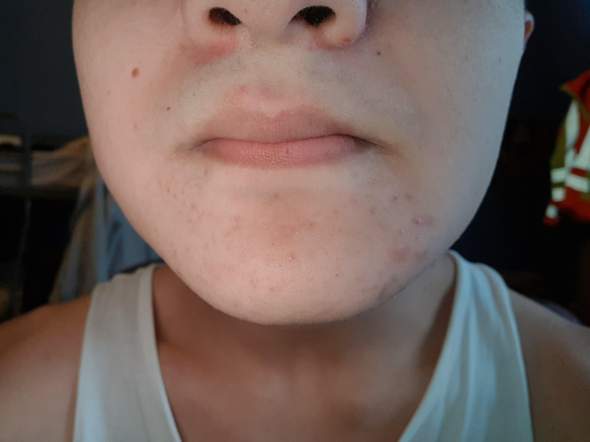 Was Kann Man Gegen Meinen Pickeligen Kinn Machen Gesundheit Und Medizin Gesundheit Haut