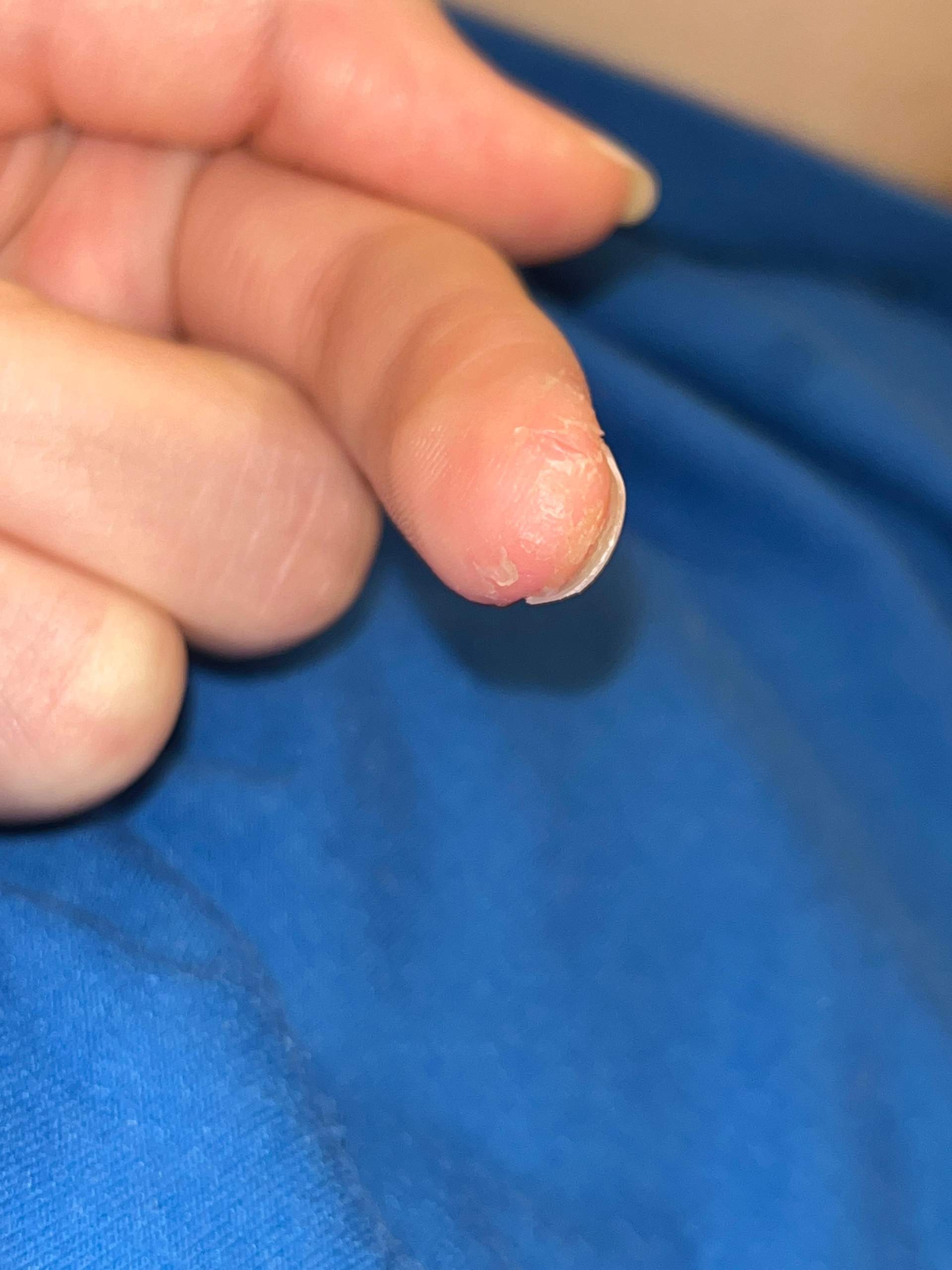 was kann man gegen schälende Fingerkuppen machen? (Haut)