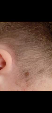haare haut muttermal