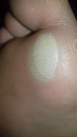 Was Kann Man Machen Gegen Blase Unterm Fuss Gesundheit Und Medizin Fusse Blasen Was Kann Man Machen Gegen Blase Unterm Fuss Gesundheit Und Medizin Fusse Blasen