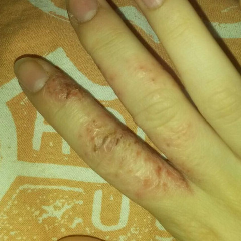 Finger - (Schmerzen, Haut, Hand)