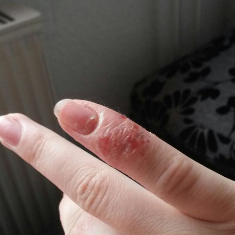 Finger  - (Schmerzen, Haut, Hand)