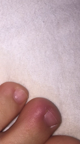 Was Konnte Das An Meinem Zeh Sein Nagelbettentzundung Gesundheit Und Medizin Was Konnte Das An Meinem Zeh Sein Nagelbettentzundung Gesundheit Und Medizin