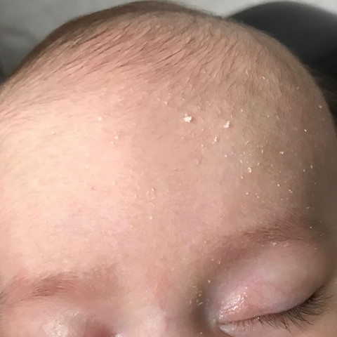 Foto Stirn  - (Gesundheit und Medizin, Baby, trockene Haut)