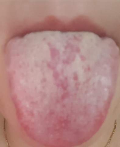 Was könnte das auf meiner Zunge sein?
