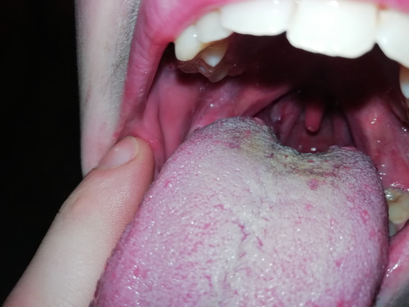 Mundsoor durch oralverkehr