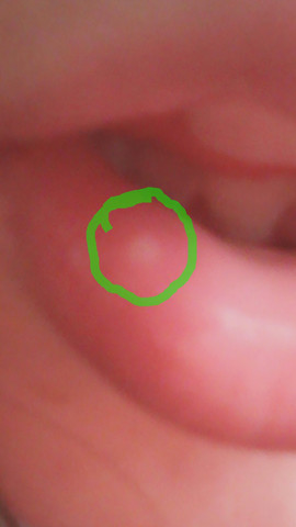 Was Konnte Das Da An Meiner Lippe Sein Mund Blase Was Konnte Das Da An Meiner Lippe Sein Mund Blase