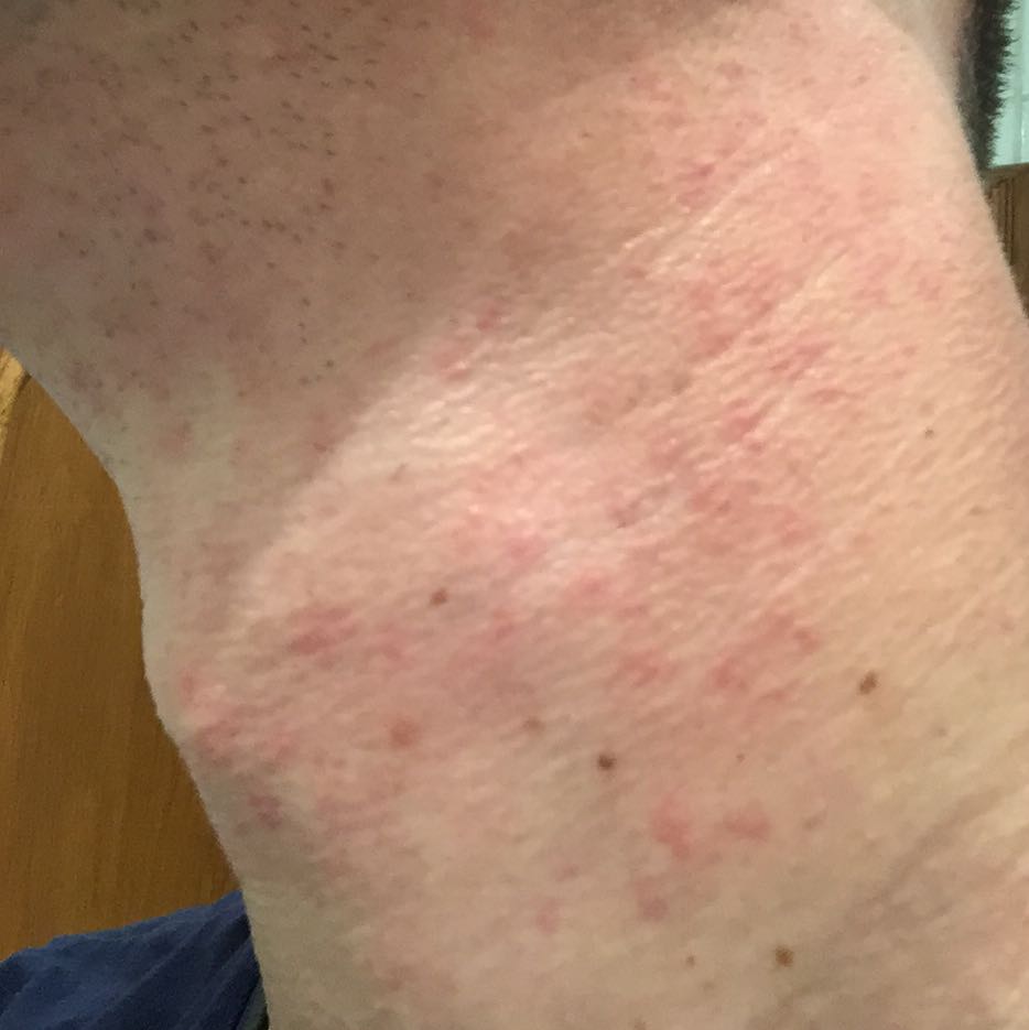 Was könnte das für ein Ausschlag am Hals sein? (Gesundheit, Arzt, Pickel) pickel am kinn und hals