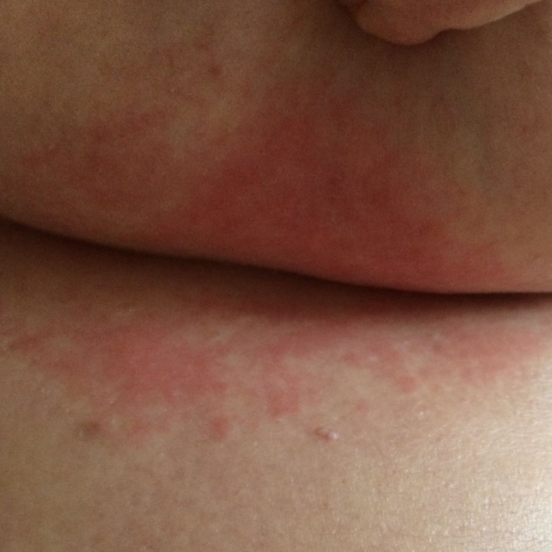 Was Konnte Das Fur Ein Ausschlag Sein Siehe Bild Gesundheit Haut Rotung Was Konnte Das Fur Ein Ausschlag Sein Siehe Bild Gesundheit Haut Rotung