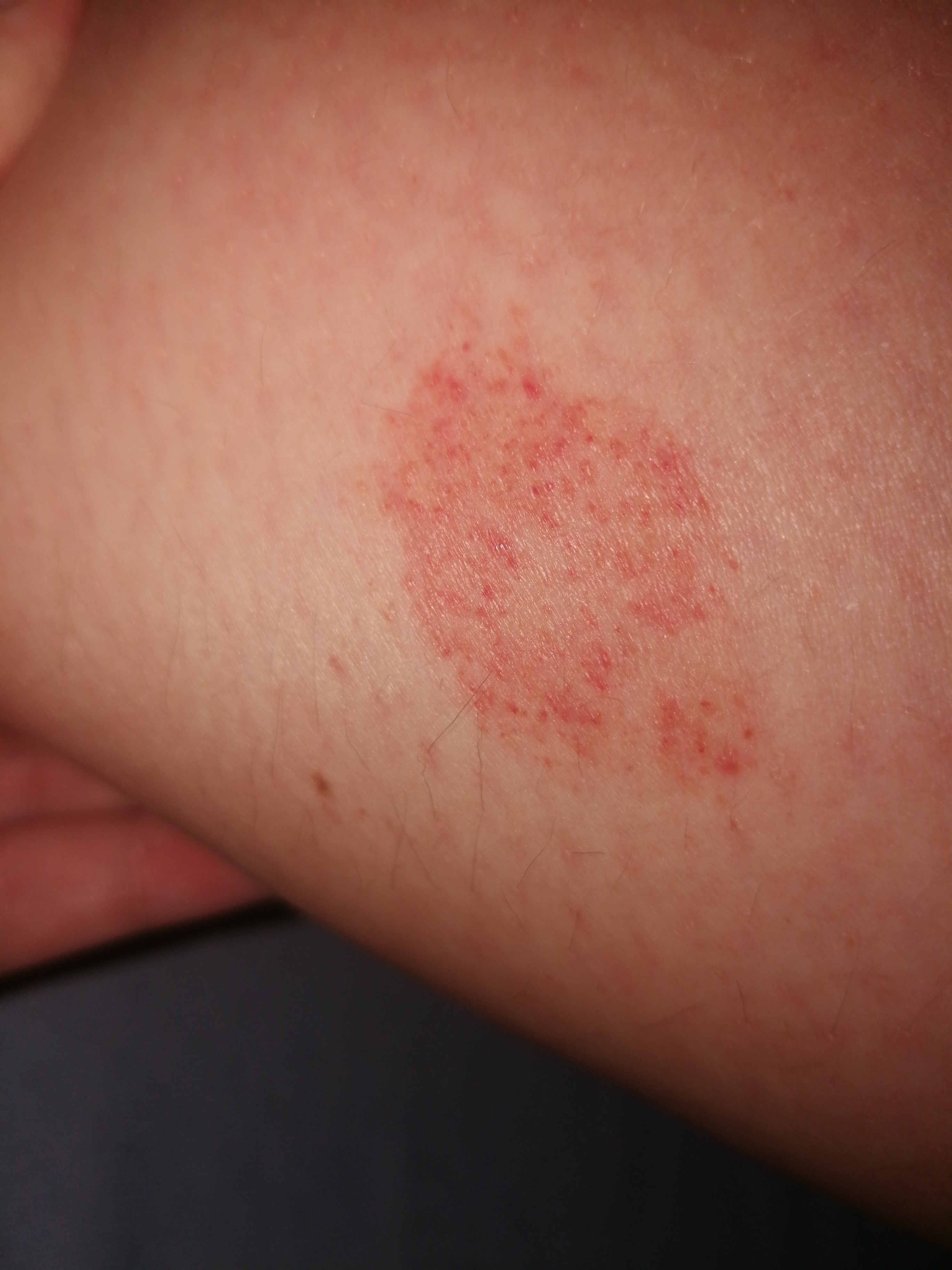 Was könnte das für ein Hautausschlag sein(am Bein)? (Arzt, Haut, Ausschlag) Was könnte das für ein Hautausschlag sein(am Bein)? (Arzt, Haut, Ausschlag)