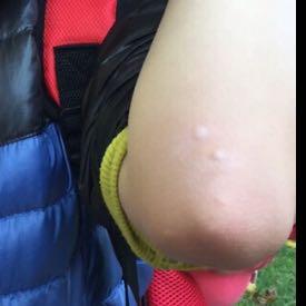 - (Allergie, buckel)