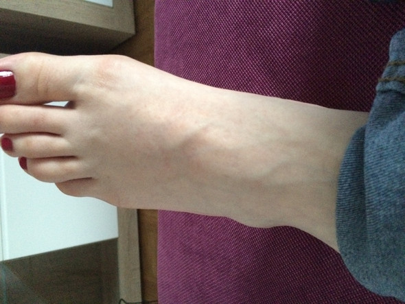 Schwellung am linken Fuß - (Arzt, Schmerzen, Schwellung)