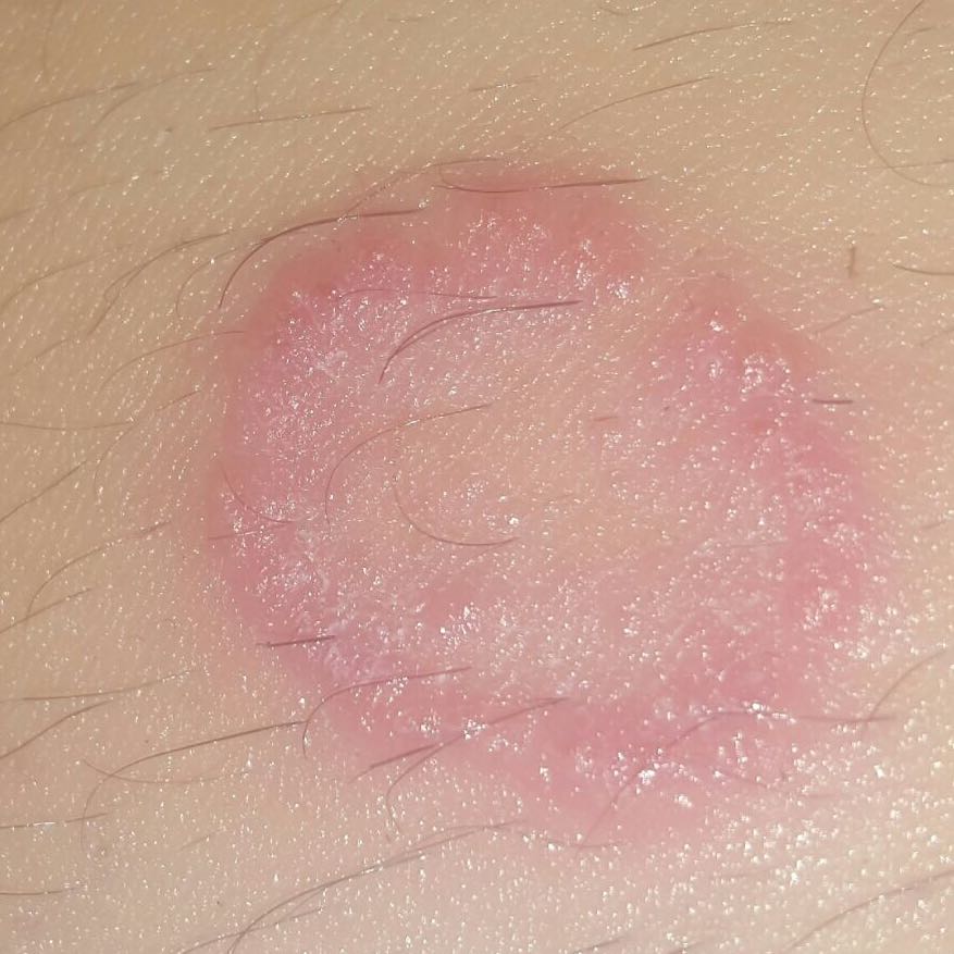 Was könnte das (roter Kreis) an meinem Bein sein? (Ausschlag, hautpilz) Was könnte das (roter Kreis) an meinem Bein sein? (Ausschlag, hautpilz)