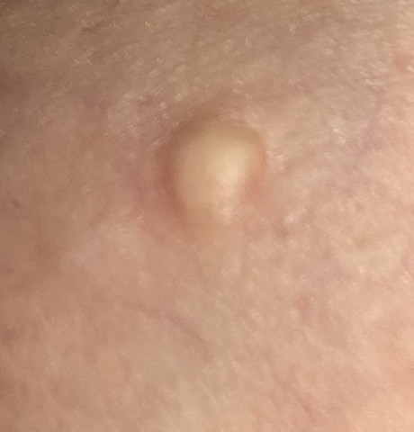 Was Konnte Das Sein Auf Der Haut Hautarzt Was Konnte Das Sein Auf Der Haut Hautarzt