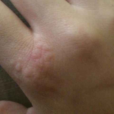 Was Konnte Das Sein Bin Ratlos Hand Punkte Jucken Was Konnte Das Sein Bin Ratlos Hand Punkte Jucken