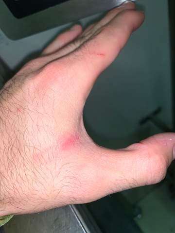 Was Konnte Das Sein Blutvergiftung Gesundheit Und Medizin Blut Was Konnte Das Sein Blutvergiftung Gesundheit Und Medizin Blut