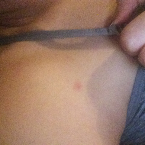 Was Konnte Das Sein Braune Flecken Auf Der Haut Bilder Braun